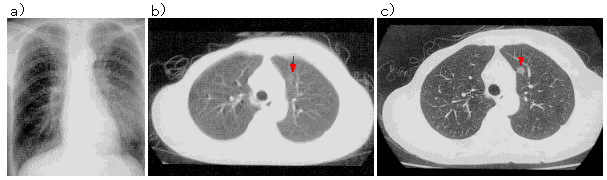 「肺癌」の画像検索結果