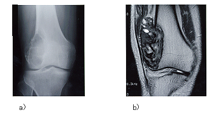 ユーイング肉腫の手術はどのくらい一般的ですか?