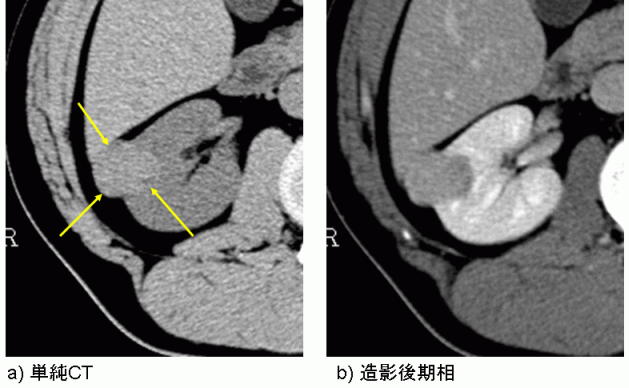 転移性腎細胞癌の症状